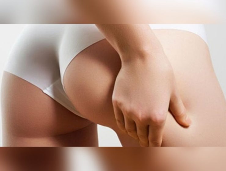 Tecniche per combattere cellulite
