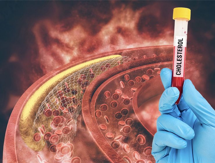 Come Ridurre Colesterolo LDL Naturalmente: Guida Completa